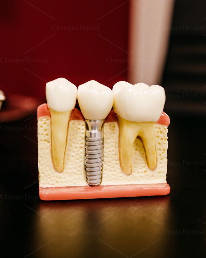 210121-banner-chingo-dental-cam-implant