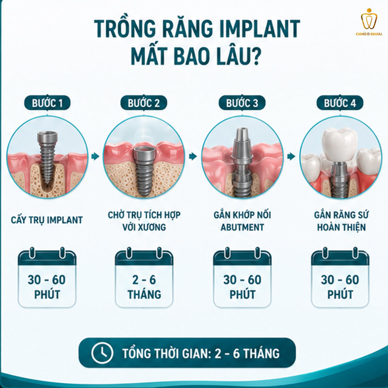 Trồng Răng Implant Mất Bao Lâu? Quy Trình, Thời Gian Phục Hồi & Những Điều Cần Biết Trước Khi Làm 2 cắm implant
