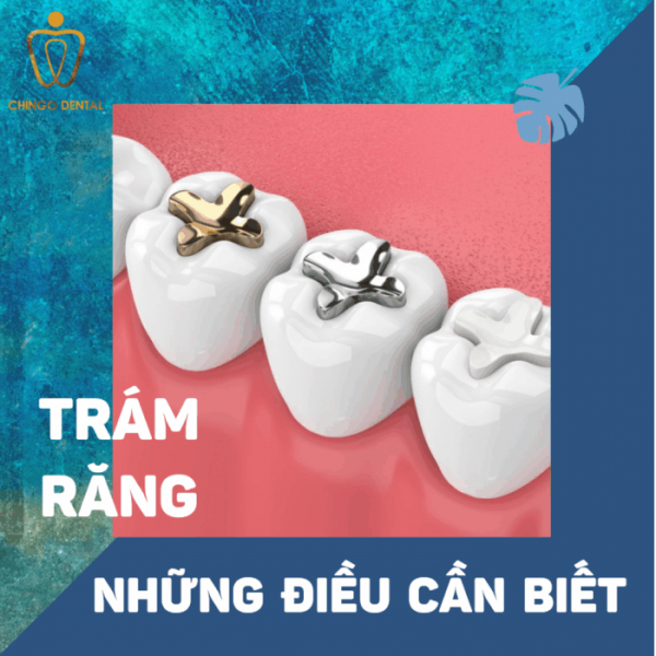 tram-rang-nhung-dieu-can-biet-ava-3-700x700-chingo-dental