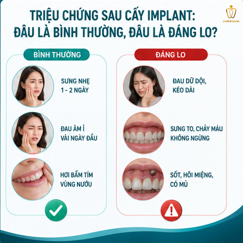 Trồng Răng Implant Mất Bao Lâu? Quy Trình, Thời Gian Phục Hồi & Những Điều Cần Biết Trước Khi Làm 4 trồng implant
