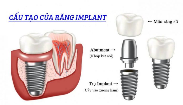 trong-rang-implant-thoi-gian-thuc-hien-chingo-dental-