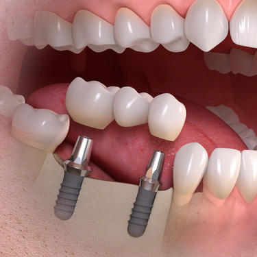 trong-rang-implant-thoi-gian-thuc-hien-chingo-dental-3