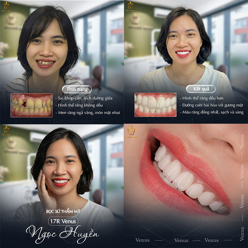 bọc răng sứ 2 răng cửa bao nhiêu tiền
