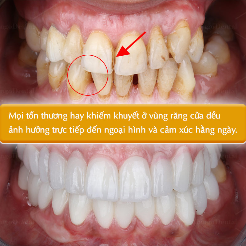 bọc răng sứ răng cửa