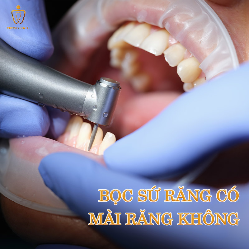 Có Nên Bọc Răng Sứ Thẩm Mỹ Không? Bác Sĩ Giải Đáp Từ A–Z Để Bạn Quyết Định Đúng 3 bọc sứ răng có mài răng không
