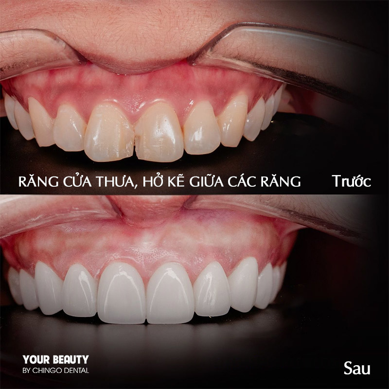 Bọc Sứ Răng Cửa – Giải Pháp Toàn Diện Cho Nụ Cười Đẹp Tự Nhiên 3 Bọc sứ răng cửa