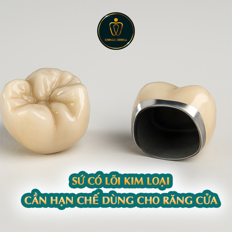 chụp răng cửa