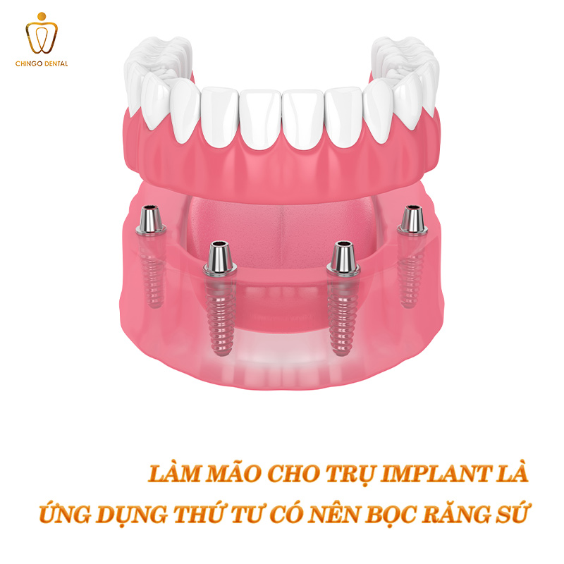 Có Nên Bọc Răng Sứ Thẩm Mỹ Không? Bác Sĩ Giải Đáp Từ A–Z Để Bạn Quyết Định Đúng 4 có nên bọc răng sứ thẩm mỹ không