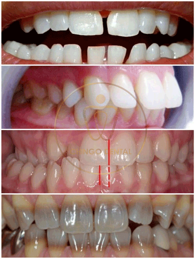 dental crown 5