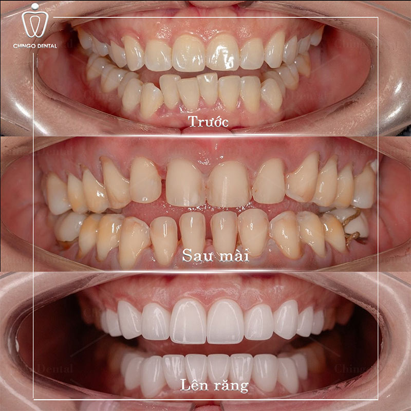 làm răng sứ răng cửa
