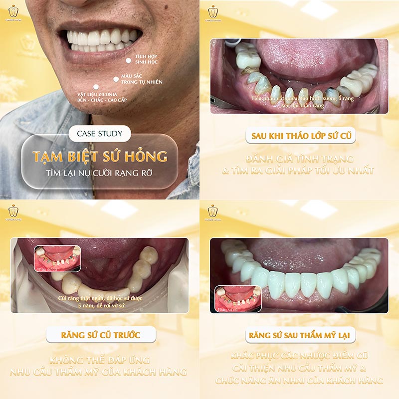 Có Nên Bọc Răng Sứ Thẩm Mỹ Không? Bác Sĩ Giải Đáp Từ A–Z Để Bạn Quyết Định Đúng 6 răng sứ bị hỏng bao lâu thì phải làm lại