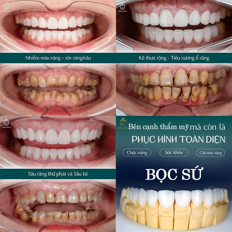 Có Nên Bọc Răng Sứ Thẩm Mỹ Không? Bác Sĩ Giải Đáp Từ A–Z Để Bạn Quyết Định Đúng 5 trường hợp nào nên bọc răng sứ
