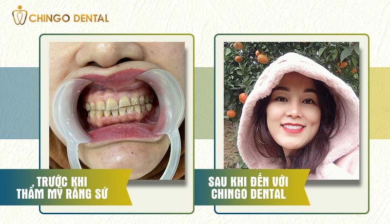 1186-thu-thuy-20r-cercon-chingo-dental