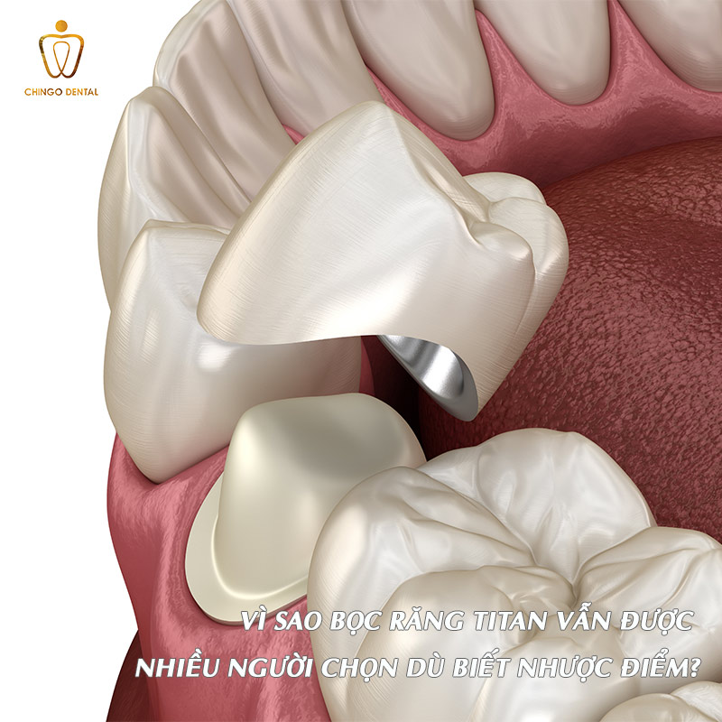 Bọc Răng Sứ Titan Có Bị Đen Không? Nguyên Nhân Thật Sự Và Cách Xử Lý Hiệu Quả 4 bọc răng sứ titan