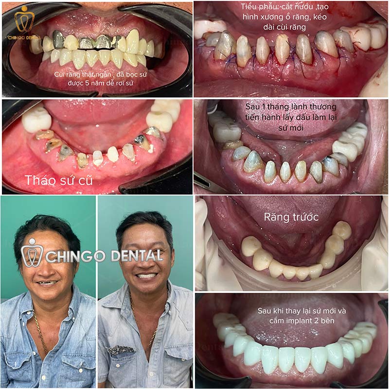 Bọc Răng Sứ Titan Có Bị Đen Không? Nguyên Nhân Thật Sự Và Cách Xử Lý Hiệu Quả 5 bọc răng sứ titan có tốt không