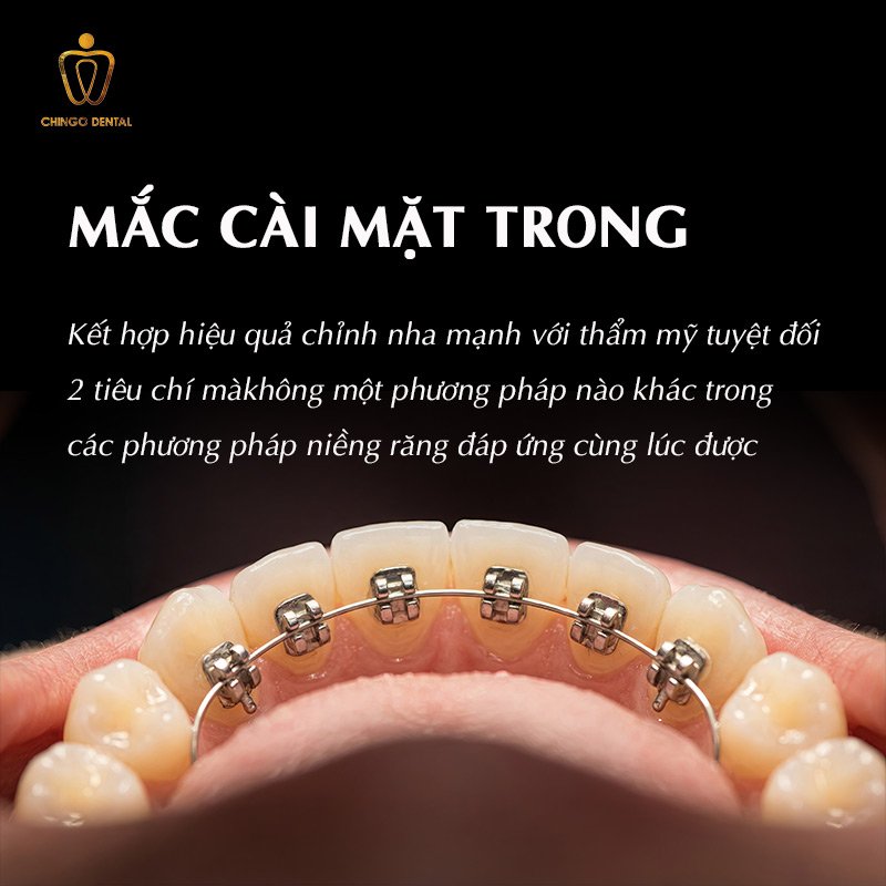 Các Phương Pháp Niềng Răng Hiện Nay — Loại Nào Phù Hợp, Có Đau Không Và Bao Nhiêu Tiền? 6 mắc cài mặt trong