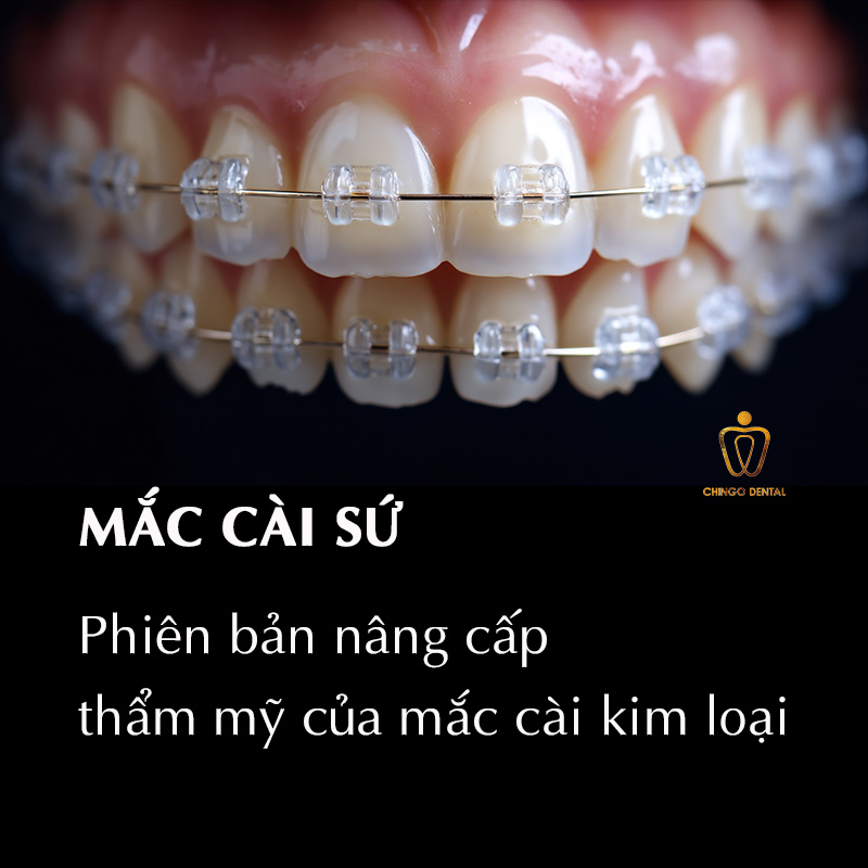 Các Phương Pháp Niềng Răng Hiện Nay — Loại Nào Phù Hợp, Có Đau Không Và Bao Nhiêu Tiền? 3 mắc cài sứ