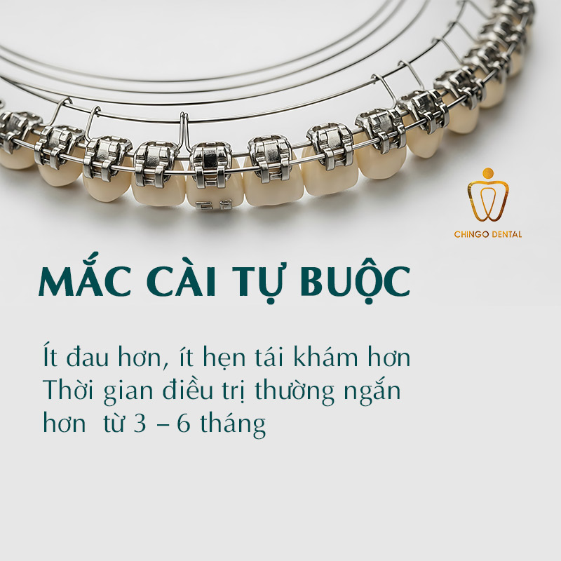 Các Phương Pháp Niềng Răng Hiện Nay — Loại Nào Phù Hợp, Có Đau Không Và Bao Nhiêu Tiền? 4 mắc cài tự buộc