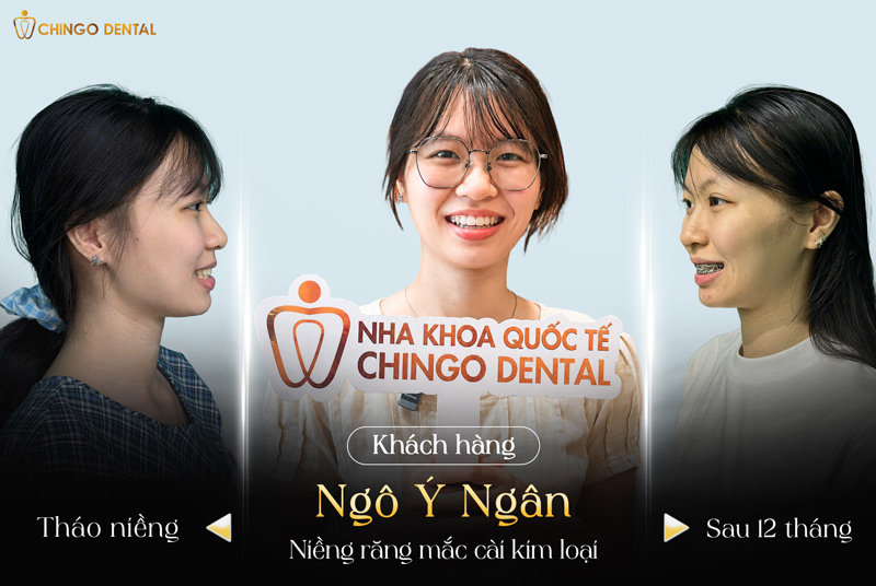 Niềng răng mắc cài – Vĩnh biệt răng thưa, hô, móm, khấp khểnh 4 niềng răng mắc cài