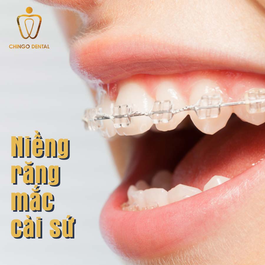 nieng-rang-mac-cai-su-web-chingo-dental