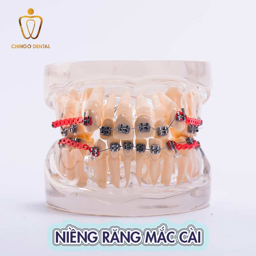nieng-rang-mac-cai-web-chingo-dental