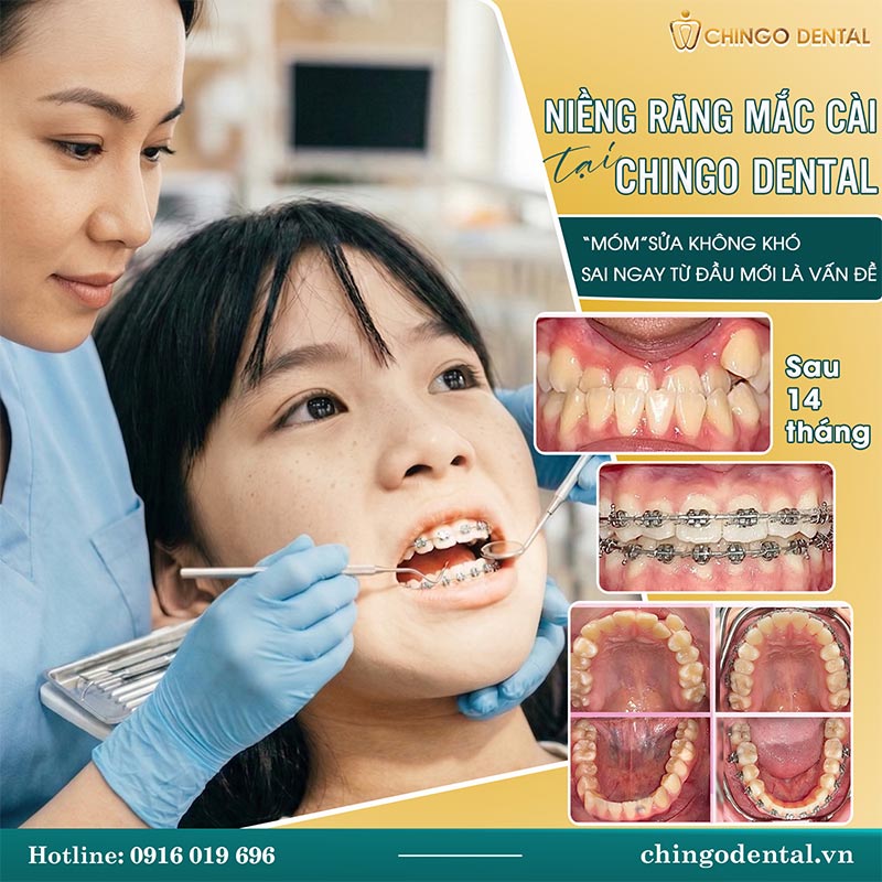 Các Phương Pháp Niềng Răng Hiện Nay — Loại Nào Phù Hợp, Có Đau Không Và Bao Nhiêu Tiền? 2 niềng răng mắc cài