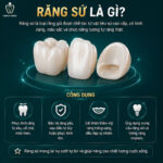 Răng Sứ Là Gì? Nhận Biết Các Loại Răng Sứ - Cẩm Nang Toàn Tập răng sứ là gì