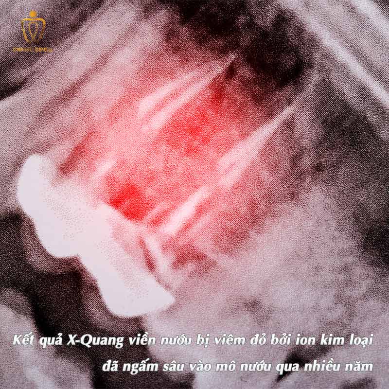 Bọc Răng Sứ Titan Có Bị Đen Không? Nguyên Nhân Thật Sự Và Cách Xử Lý Hiệu Quả 2 răng sứ titan có bị đen không