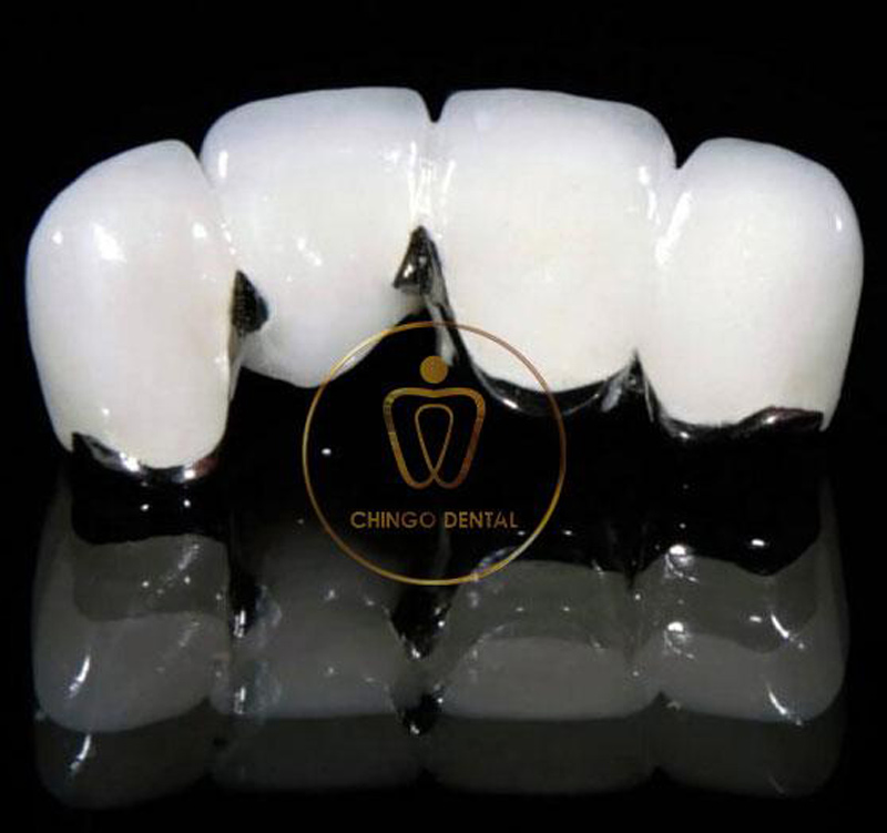 Có Nên Làm Răng Sứ Titan Không? Cẩm Nang Toàn Diện Với Phân Tích Từ Chuyên Gia 1 làm răng sứ Titan