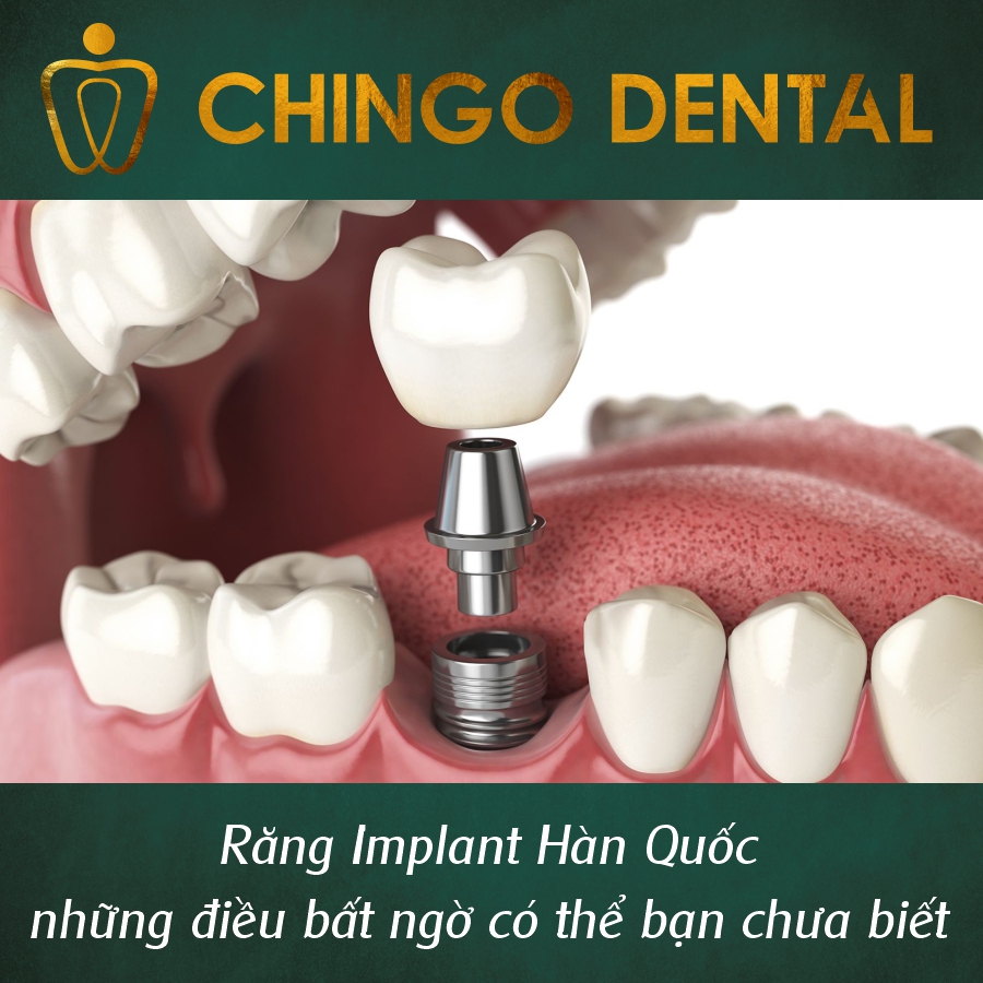 Rang Implant Han Quoc Chingo Dental