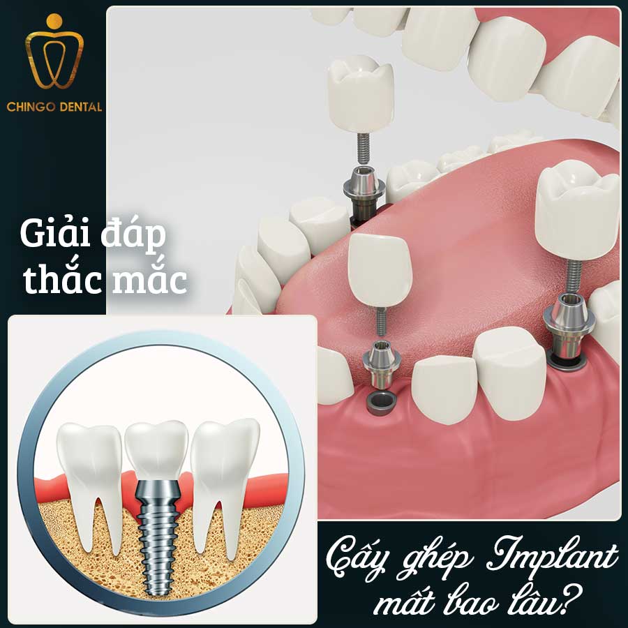 Thoi Gian Cay Ghep Implant Chingo Dental