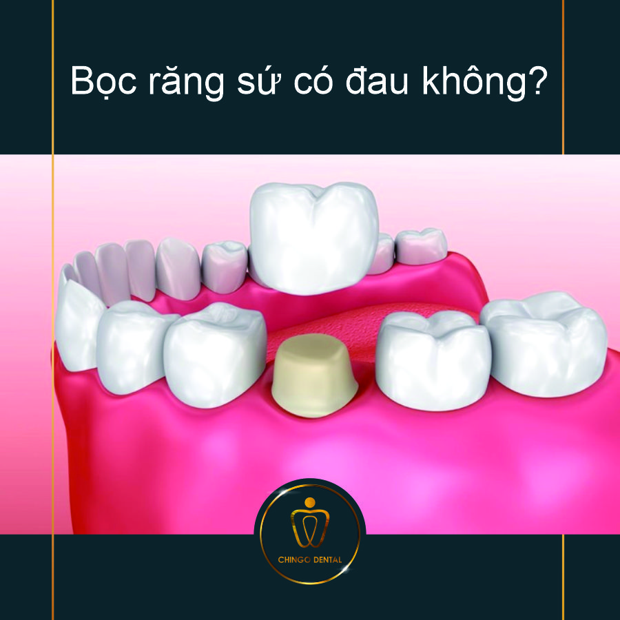 Boc Rang Su Co Dau Khong Chingo Dental