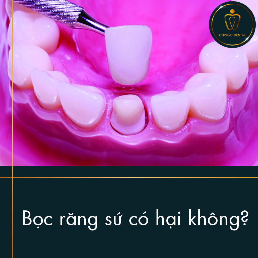 Boc Rang Su Co Hai Khong Chingo Dental