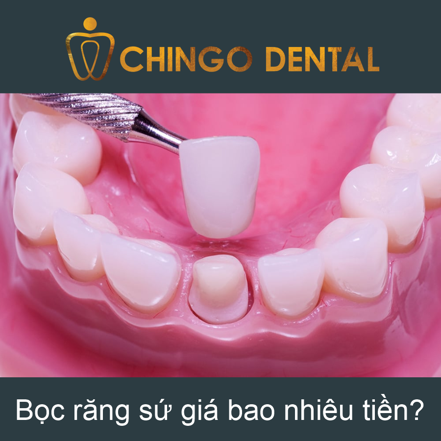 Boc Rang Su Gia Bao Nhieu Tien Chingo Dental