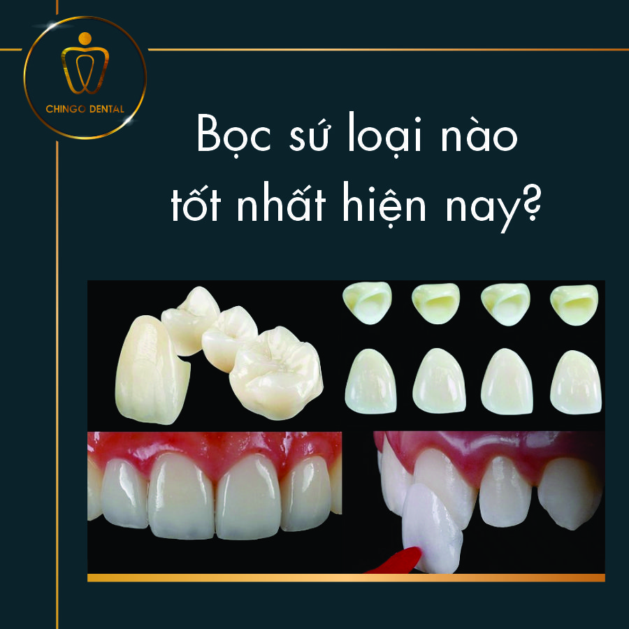 Boc Rang Su Loai Nao Tot Nhat Hien Nay Chingo Dental