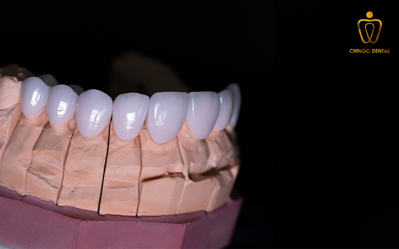 bọc răng sứ ở đâu tốt và chất lượng