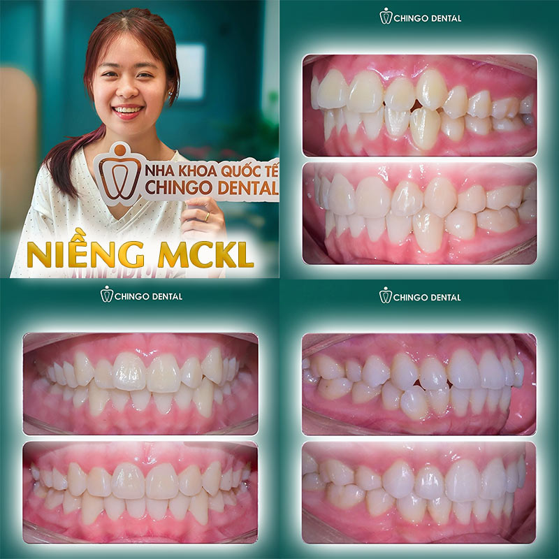 Niềng Răng Có Đau Không? Giải Đáp Toàn Diện Từng Giai Đoạn Cho Người Mới Bắt Đầu 5 Cách giảm đau khi niềng răng tại nhà