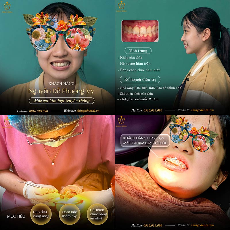 Niềng Răng Có Đau Không? Giải Đáp Toàn Diện Từng Giai Đoạn Cho Người Mới Bắt Đầu 2 Cảm giác khi mới gắn mắc cài.