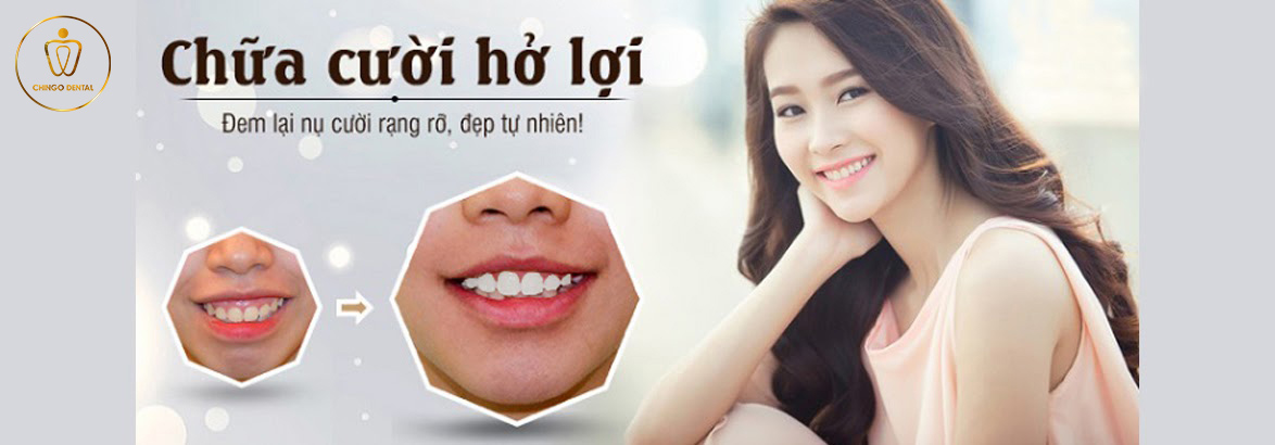 Chữa Cười Hở Lợi - Các Giải Pháp Điều Trị An Toàn, Không Tái Phát 1 Chữa cười hở lợi không phẫu thuật