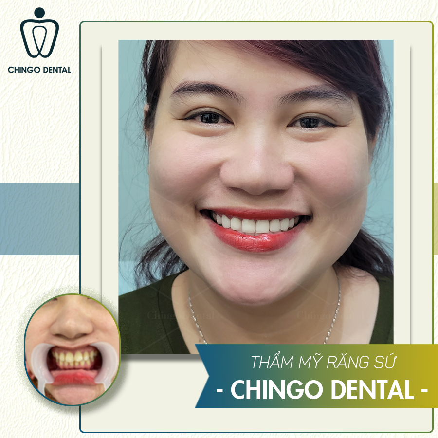 Co Nen Boc Rang Su Chingo Dental 3