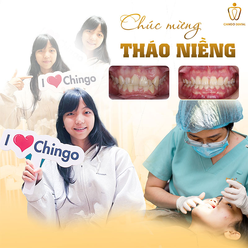 Thời Điểm Nào Thích Hợp Để Niềng Răng? Giải Đáp Toàn Diện Theo Từng Độ Tuổi 1 khi nào nên niềng răng