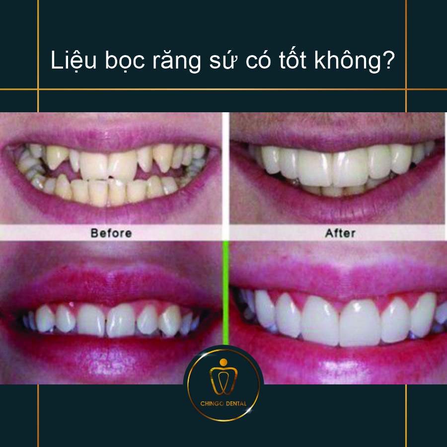 Lieu Boc Rang Su Co Tot Khong Chingo Dental