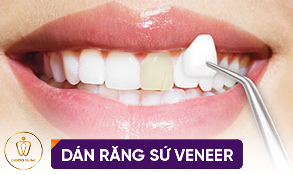 Mat Dan Su Veneer Chingo Dental 2
