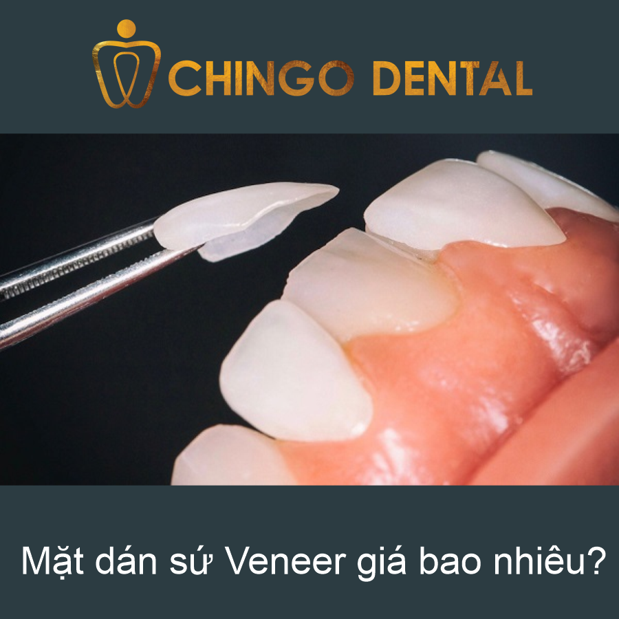 Mat Dan Su Veneer Gia Bao Nhieu Chingo Dental