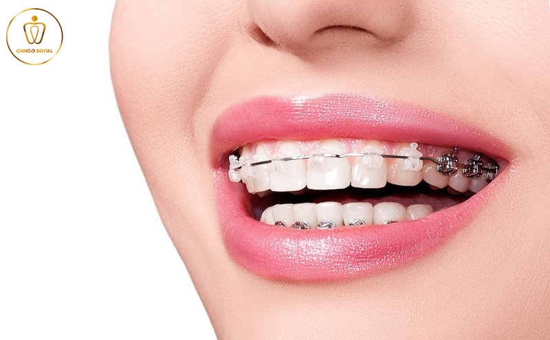 dental-braces-everything-you-need-to-know-chingo