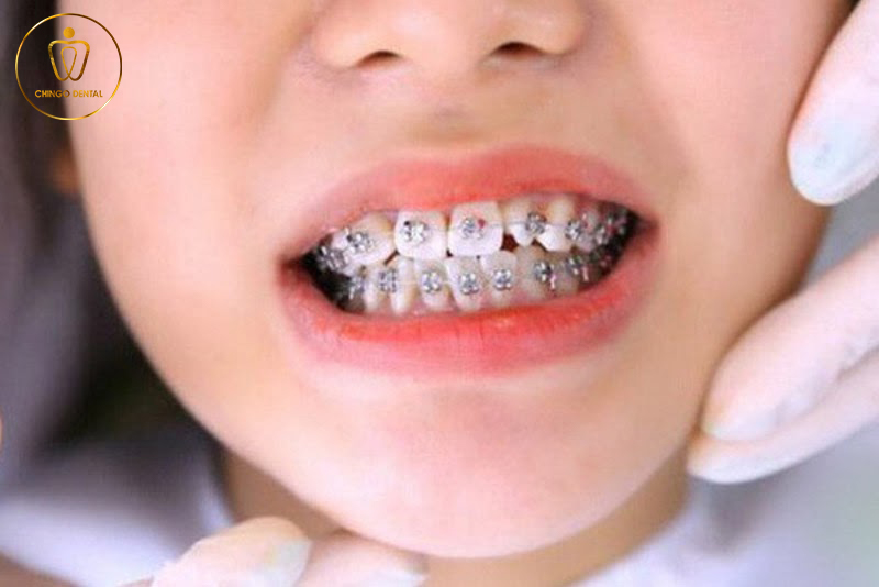 dental-braces-everything-you-need-to-know-chingo-2