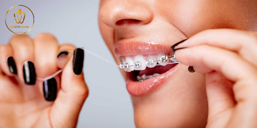 dental-braces-everything-you-need-to-know-chingo-4