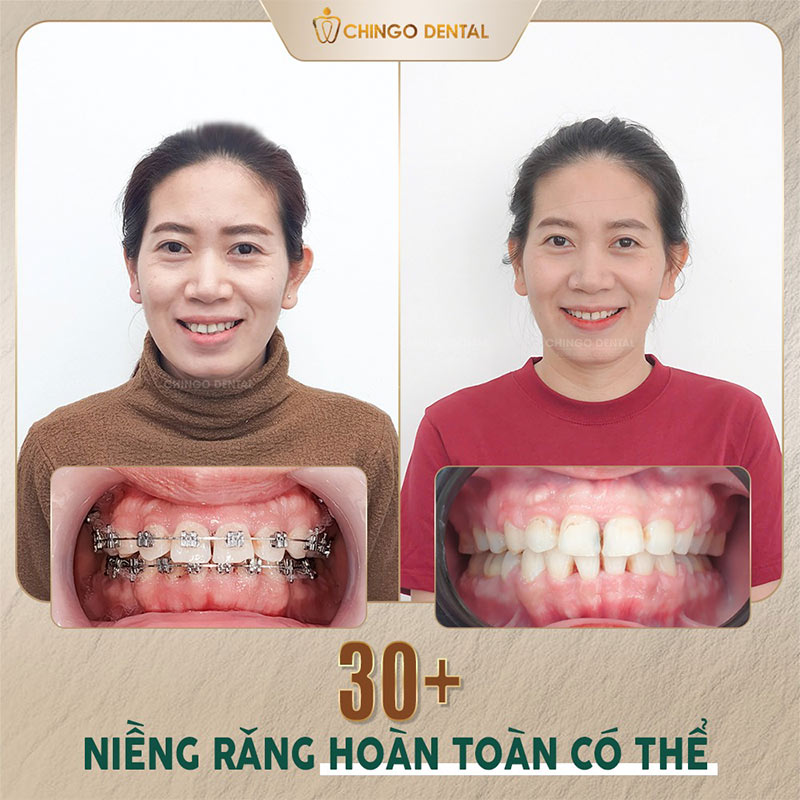 Thời Điểm Nào Thích Hợp Để Niềng Răng? Giải Đáp Toàn Diện Theo Từng Độ Tuổi 5 Niềng răng cho người trưởng thành