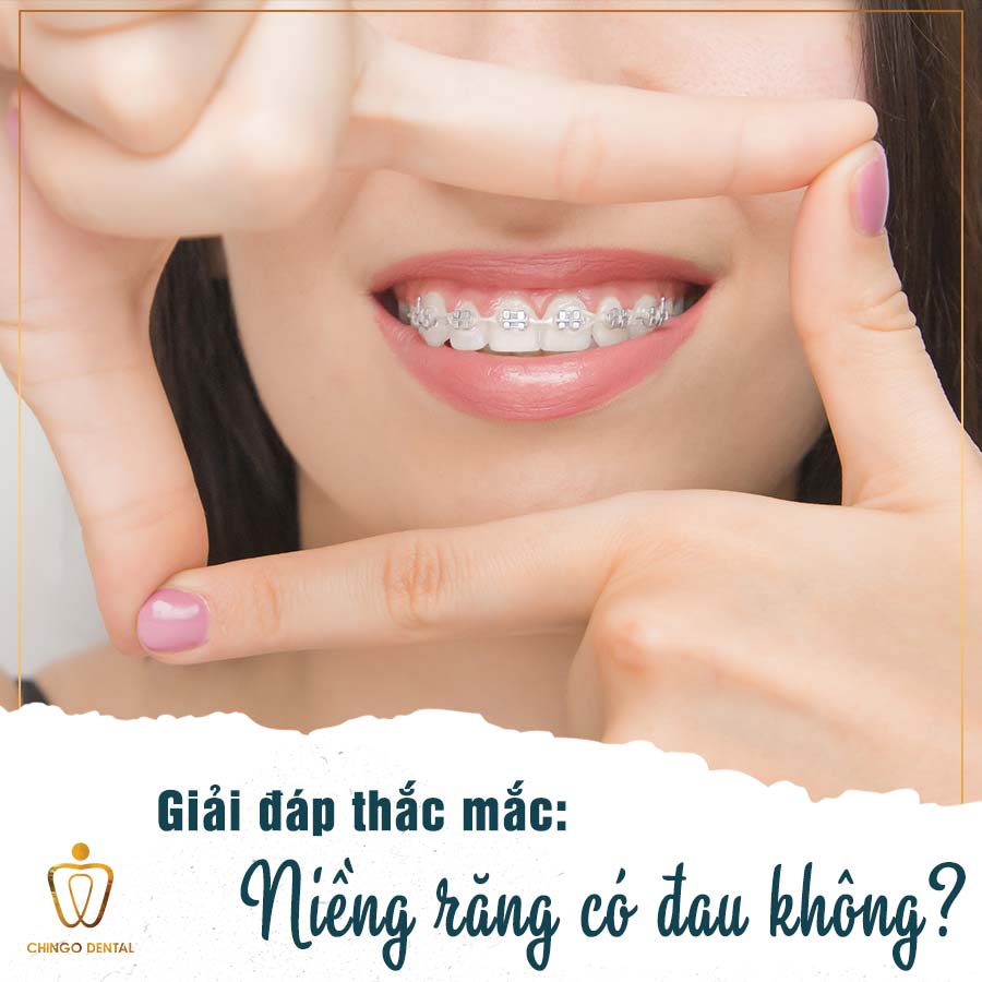 Nieng Rang Co Dau Khong Chingo Dental