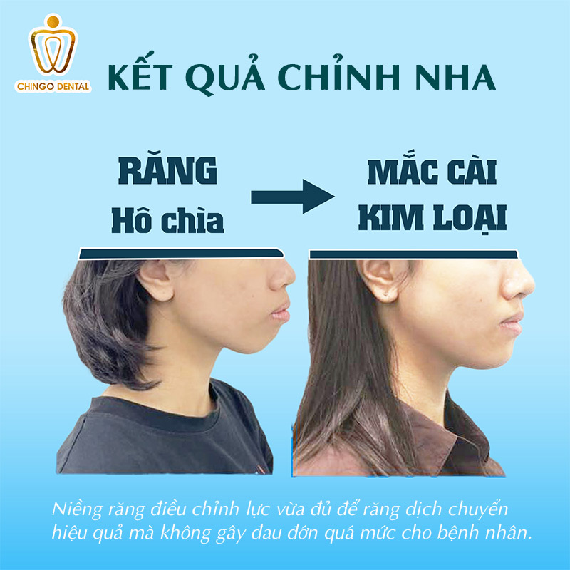 Niềng Răng Có Đau Không? Giải Đáp Toàn Diện Từng Giai Đoạn Cho Người Mới Bắt Đầu 1 niềng răng có đau không